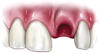 avulsed tooth.jpg
