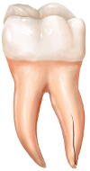 cracked-tooth-4 root fracture.jpg